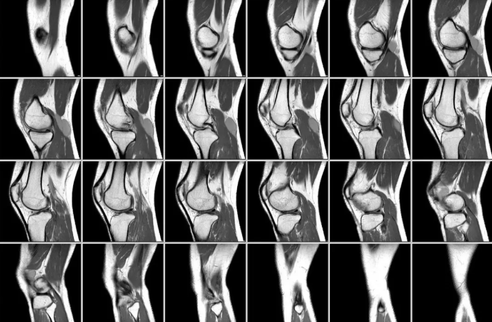 髌股关节炎的病因、诊断与康复治疗方法