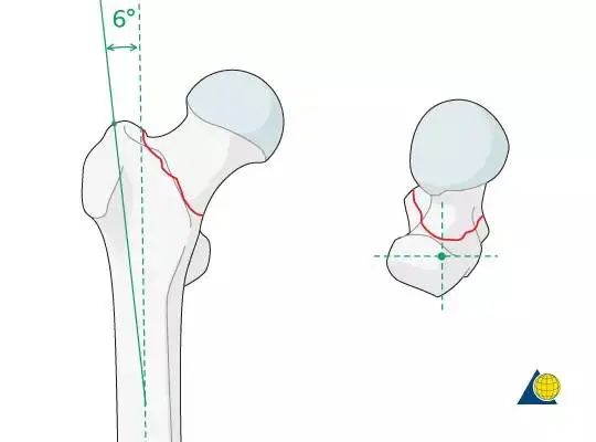 股骨粗隆间骨折PFNA内固定的4大关键