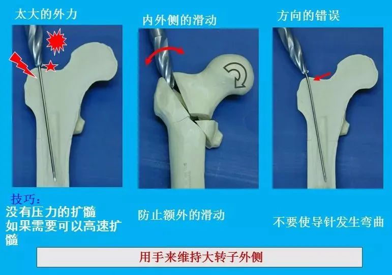 股骨粗隆间骨折PFNA内固定的4大关键