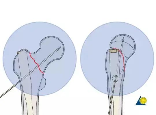 股骨粗隆间骨折PFNA内固定的4大关键