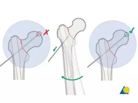 股骨粗隆间骨折PFNA内固定的4大关键