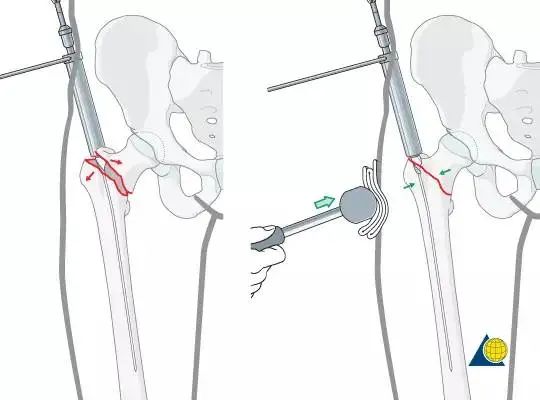 股骨粗隆间骨折PFNA内固定的4大关键