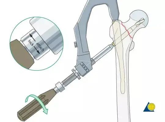 股骨粗隆间骨折PFNA内固定的4大关键