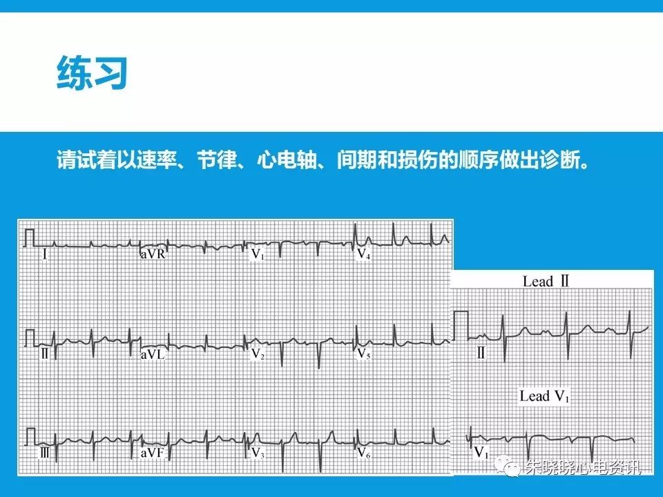 心电图评估5步法