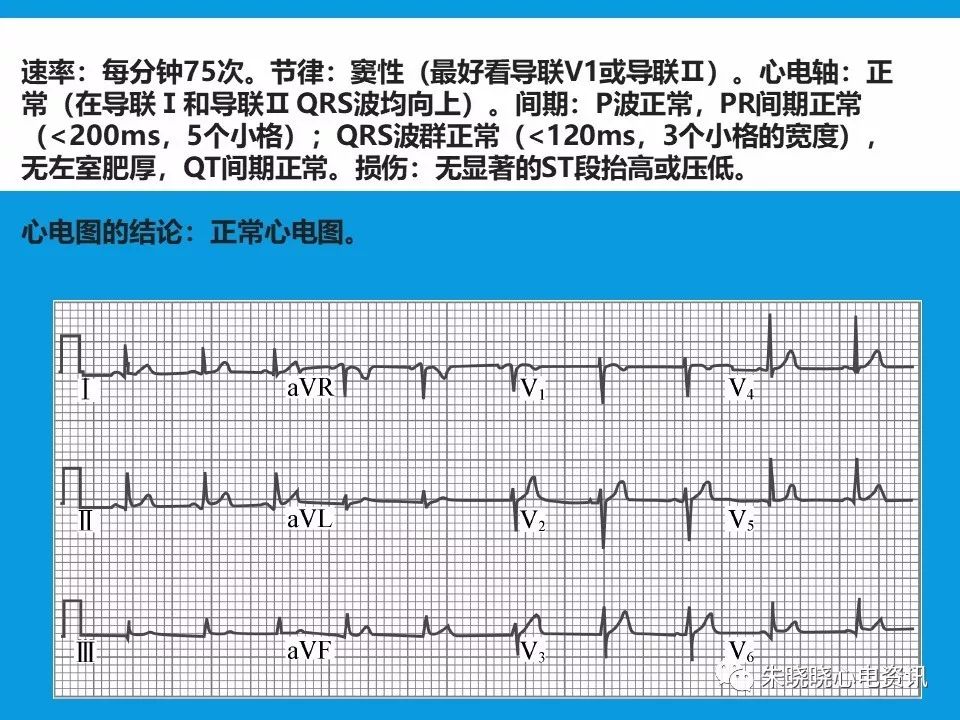 心电图评估5步法