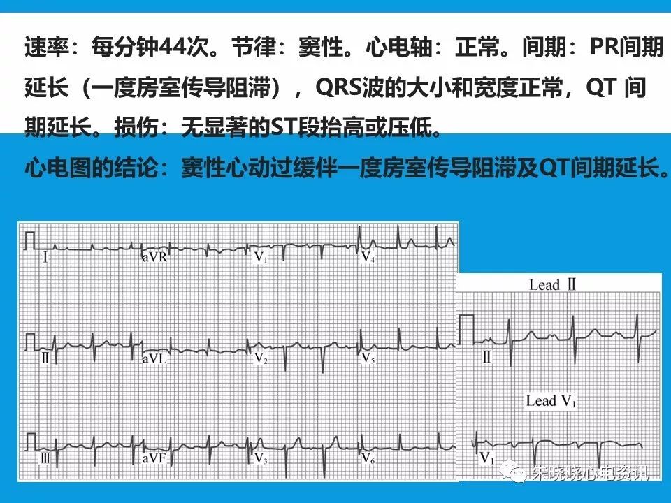 心电图评估5步法