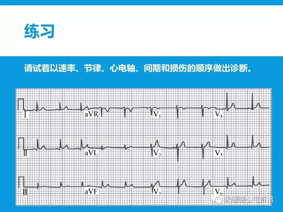 心电图评估5步法