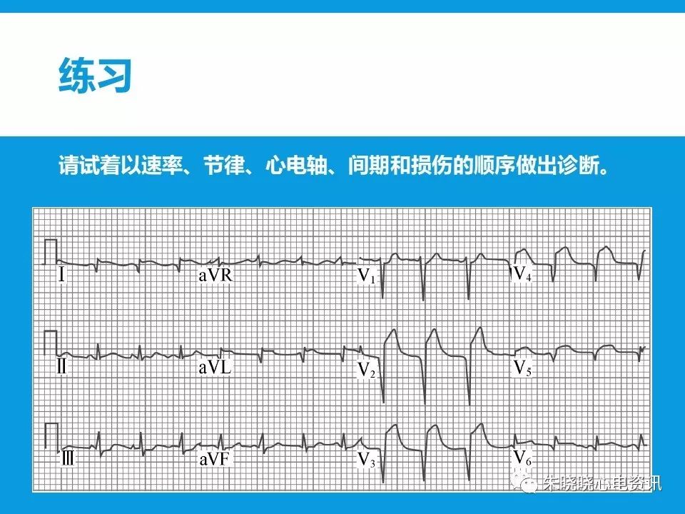 心电图评估5步法