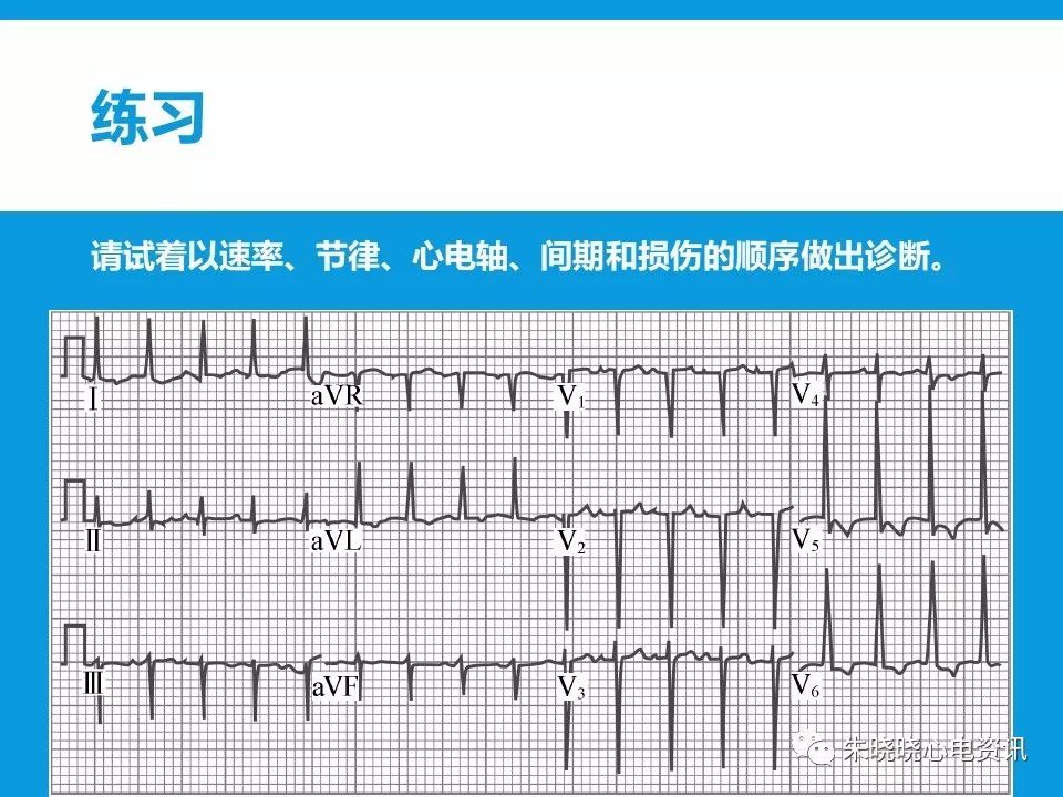 心电图评估5步法