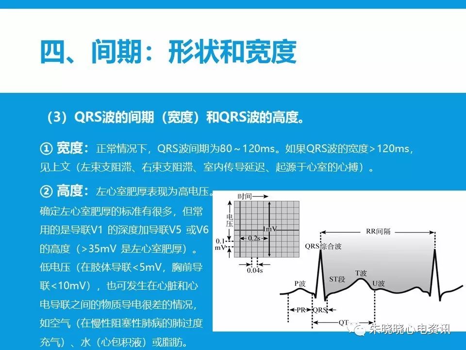 心电图评估5步法