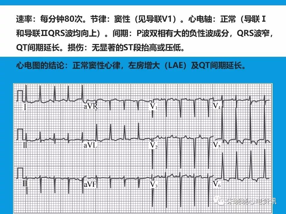 心电图评估5步法