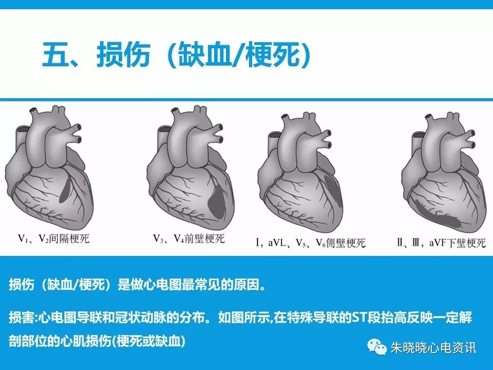 心电图评估5步法