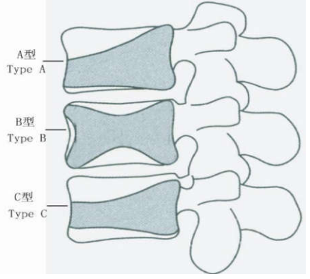 椎体压缩性骨折分度图图片