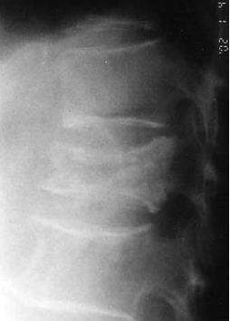 骨质疏松性椎体压缩骨折分型分级系统概述