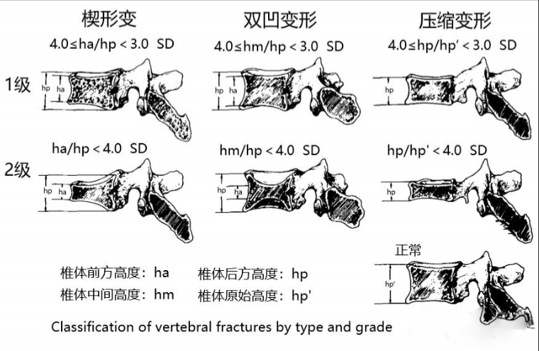 骨质疏松性椎体压缩骨折分型分级系统概述