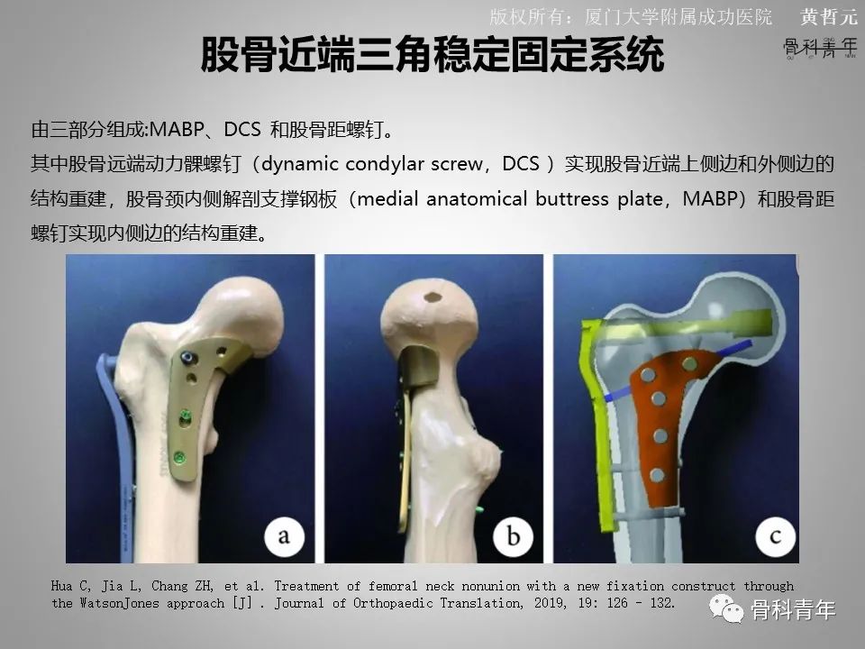 一文掌握股骨颈骨折的分型、复位与内固定！