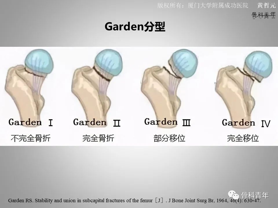 一文掌握股骨颈骨折的分型、复位与内固定！