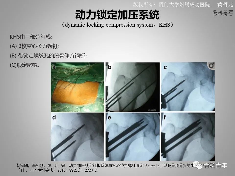 一文掌握股骨颈骨折的分型、复位与内固定！