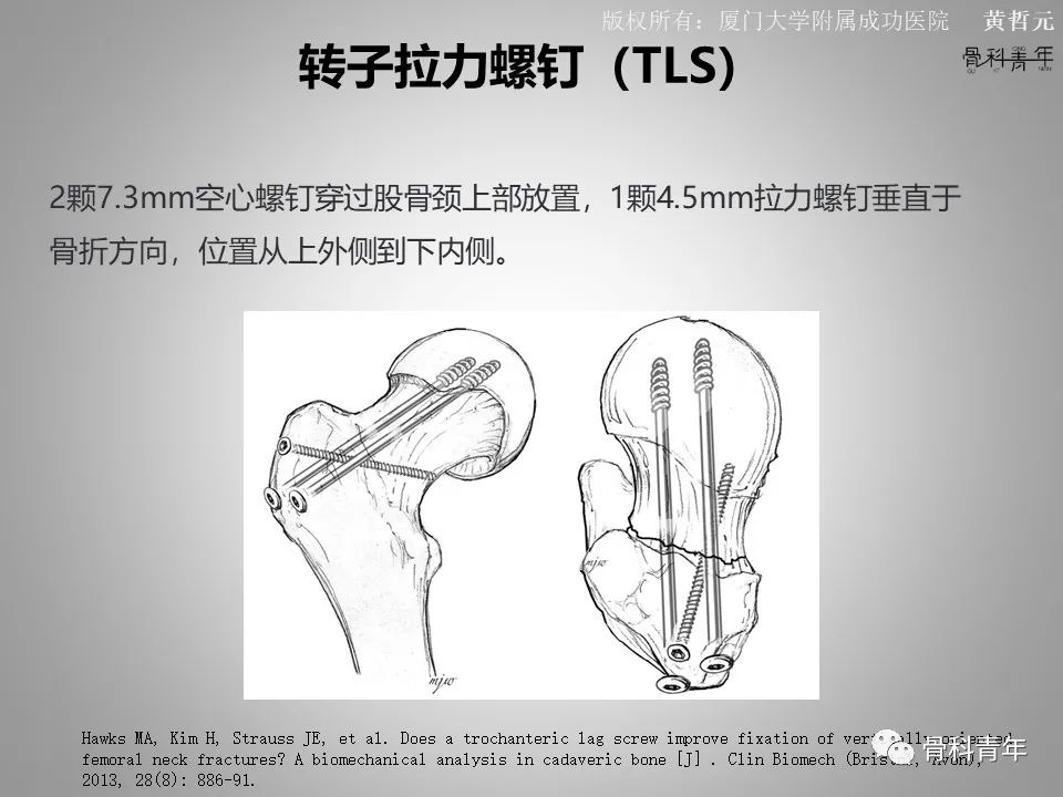 一文掌握股骨颈骨折的分型、复位与内固定！