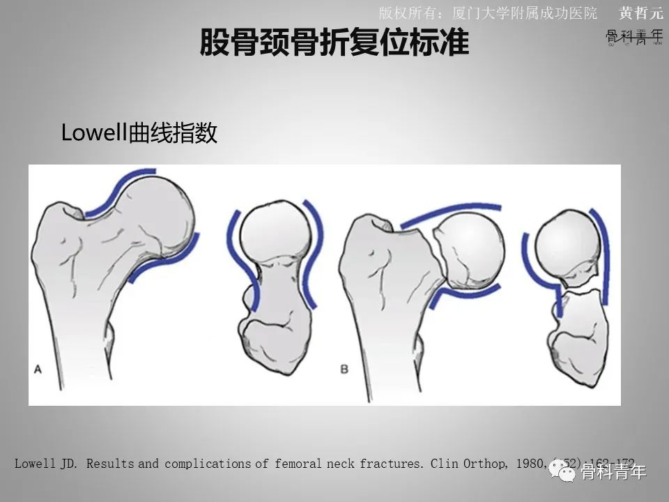 一文掌握股骨颈骨折的分型、复位与内固定！