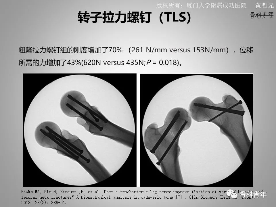 一文掌握股骨颈骨折的分型、复位与内固定！