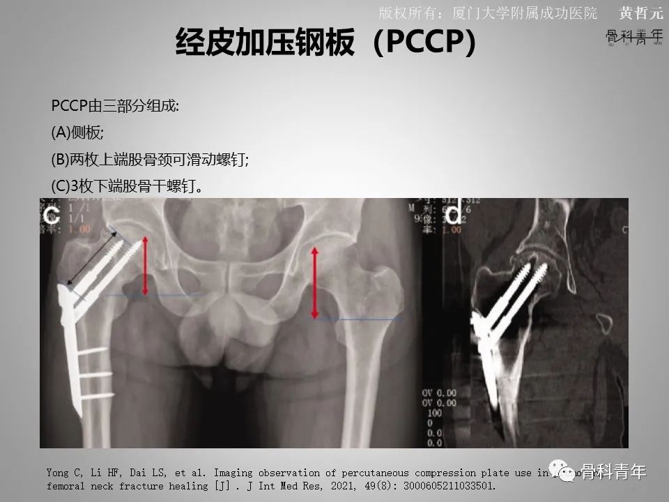一文掌握股骨颈骨折的分型、复位与内固定！