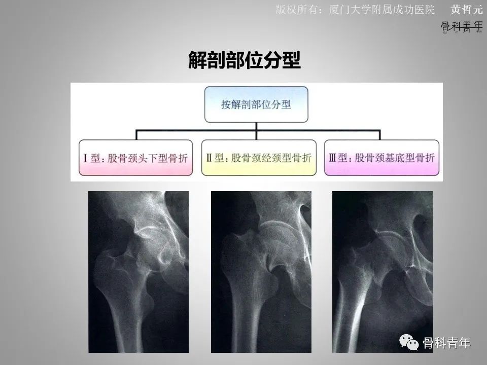 一文掌握股骨颈骨折的分型、复位与内固定！