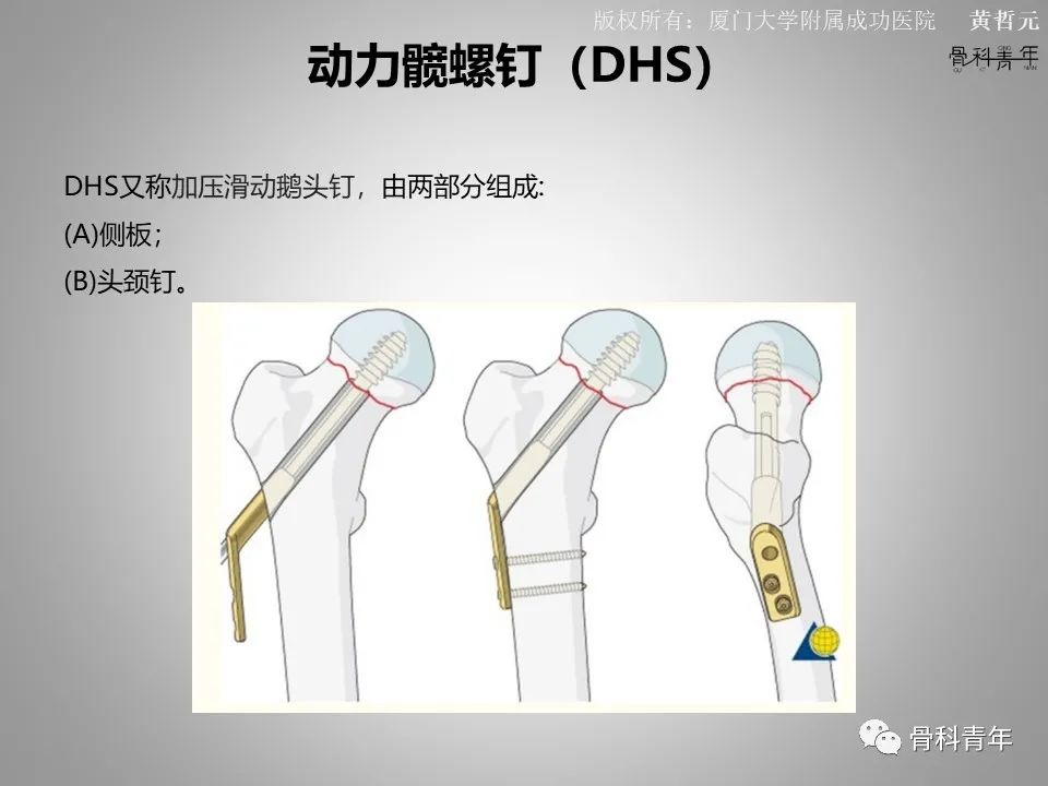 一文掌握股骨颈骨折的分型、复位与内固定！