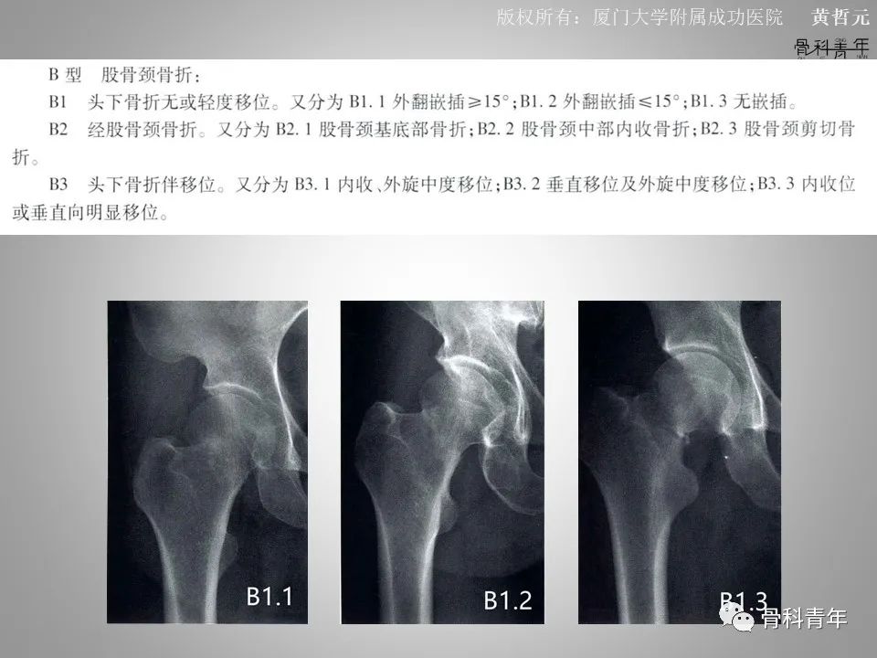 一文掌握股骨颈骨折的分型、复位与内固定！