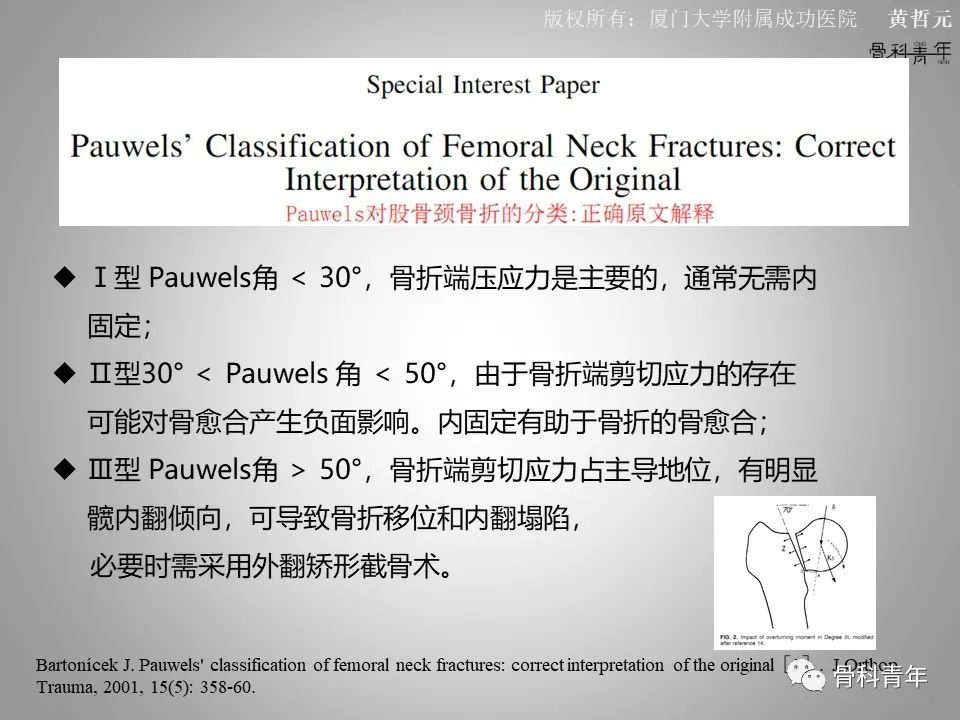 一文掌握股骨颈骨折的分型、复位与内固定！