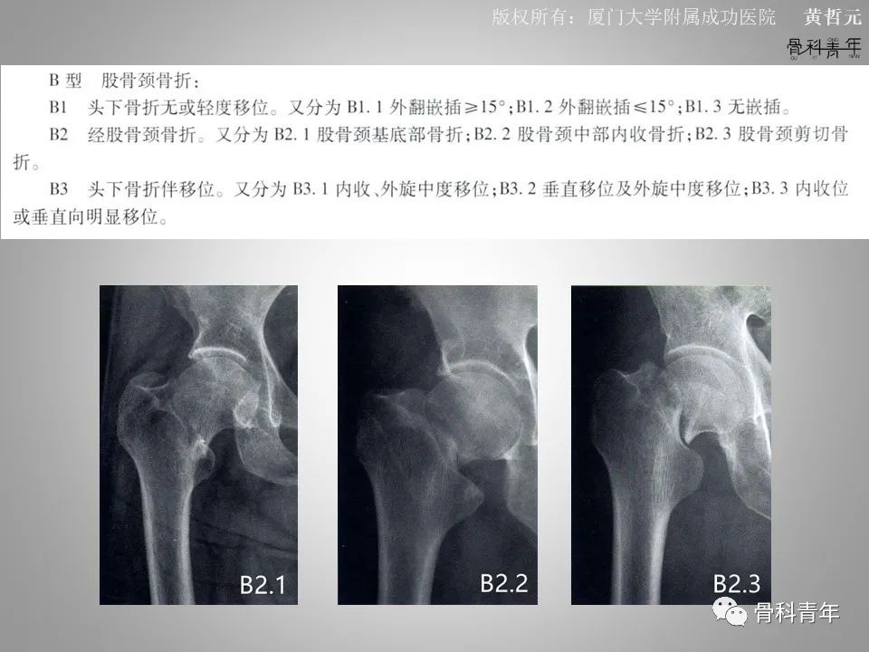 一文掌握股骨颈骨折的分型、复位与内固定！