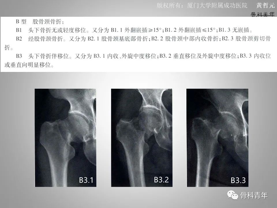 一文掌握股骨颈骨折的分型、复位与内固定！