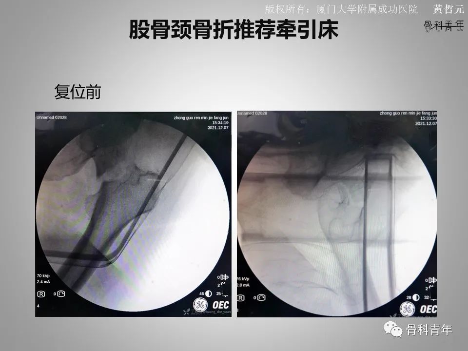 一文掌握股骨颈骨折的分型、复位与内固定！