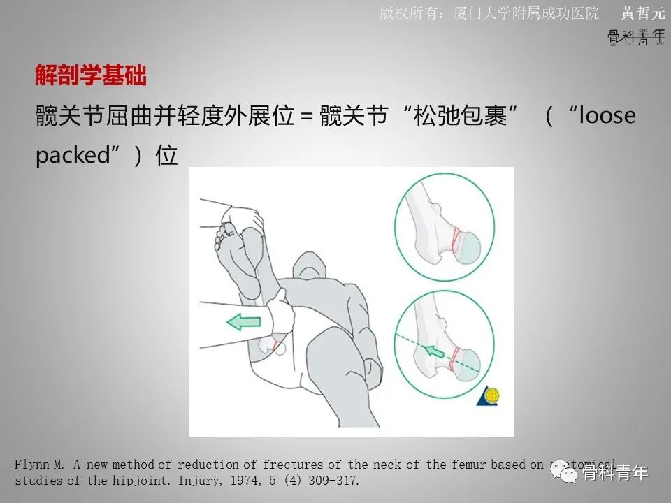一文掌握股骨颈骨折的分型、复位与内固定！