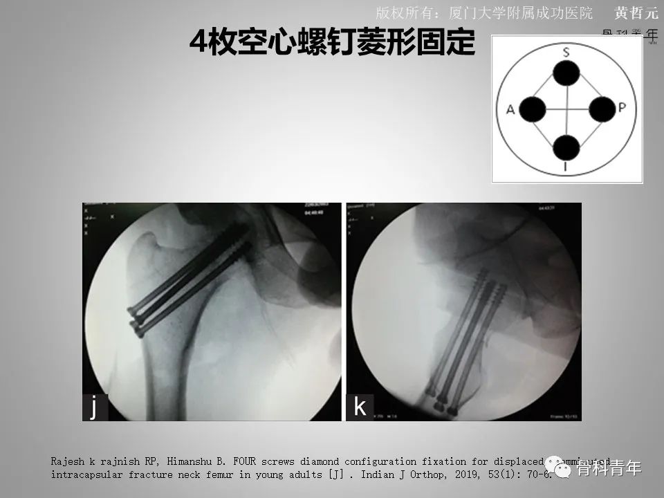 一文掌握股骨颈骨折的分型、复位与内固定！