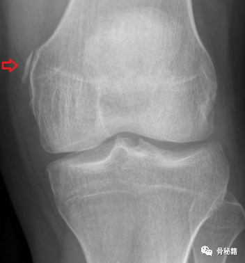 截腿踢与膝关节不愉快三联征损伤，你了解吗？