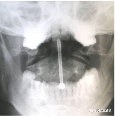 齿状突螺钉的手术细节和相关问题