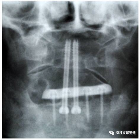 齿状突螺钉的手术细节和相关问题