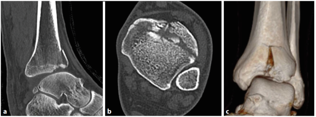 多图详解：“前踝”骨折的特点、分类及治疗