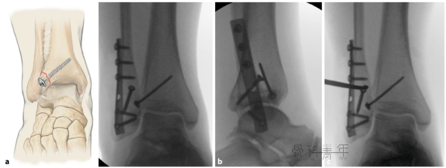 多图详解：“前踝”骨折的特点、分类及治疗