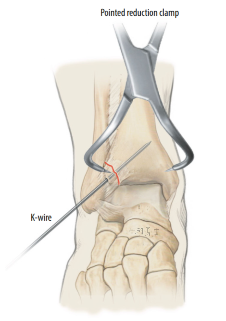 多图详解：“前踝”骨折的特点、分类及治疗