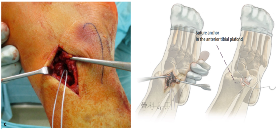 多图详解：“前踝”骨折的特点、分类及治疗