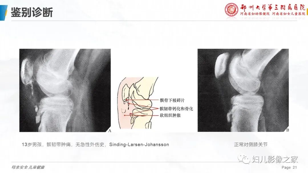 胫骨结节骨软骨炎的影像诊断