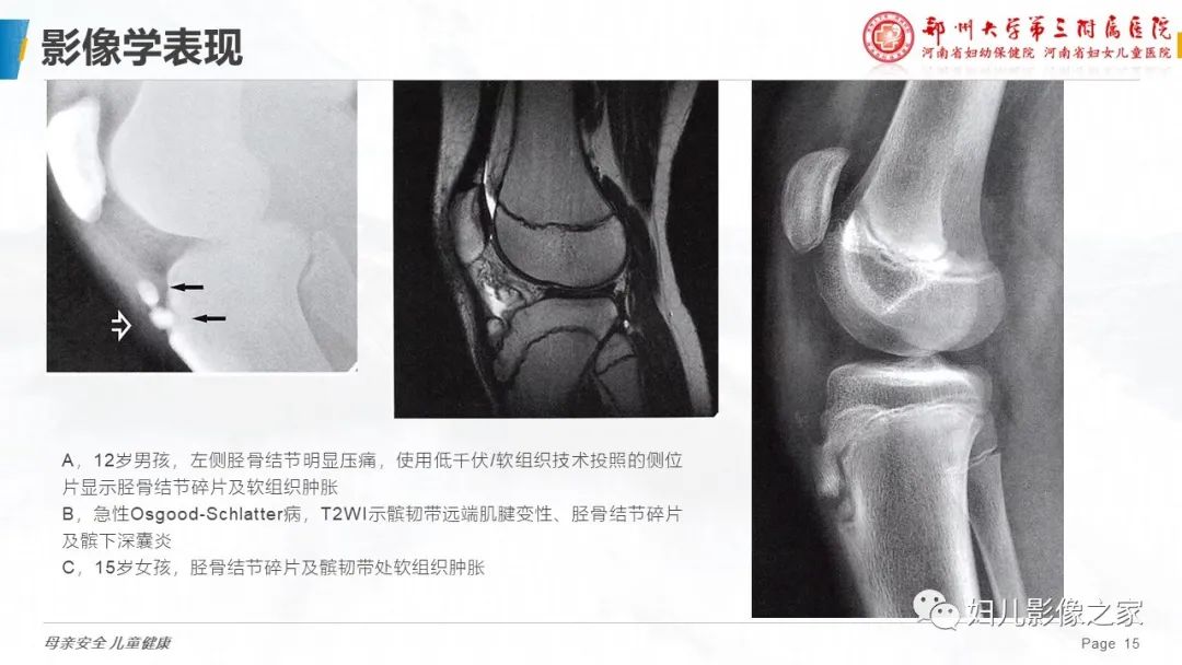 胫骨结节骨软骨炎的影像诊断