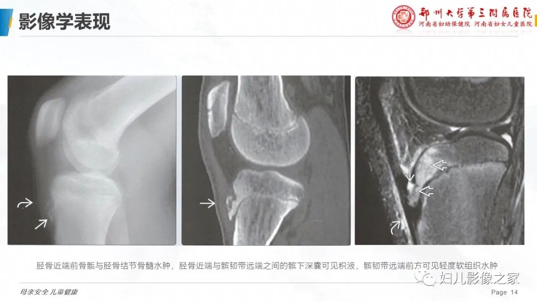 胫骨结节骨软骨炎的影像诊断