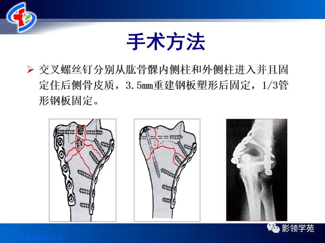 10种上肢骨折的影像学表现