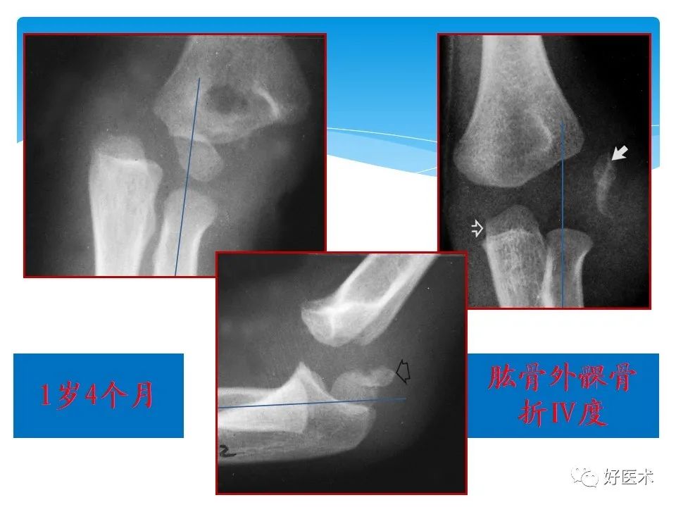 儿童肘关节周围骨骺损伤及其诊断
