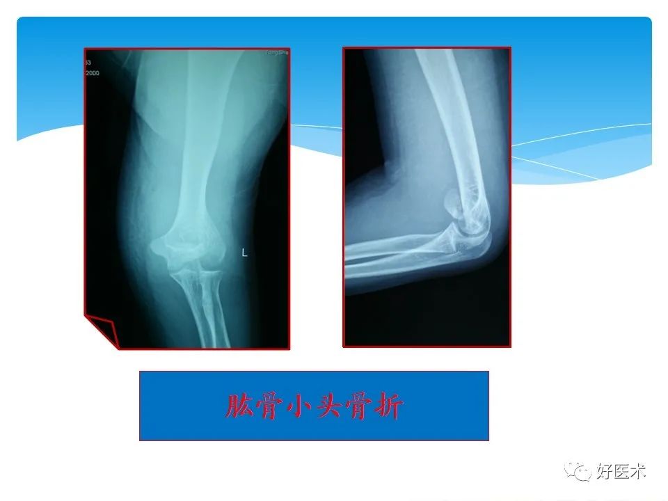 儿童肘关节周围骨骺损伤及其诊断
