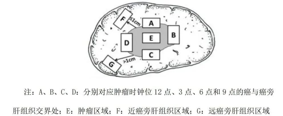 全文收藏丨原发性肝癌诊疗指南(2022年版)