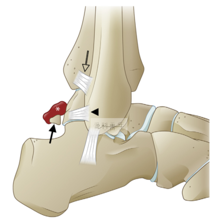 5大踝关节撞击综合征的解剖因素、影像表现、诊断与治疗
